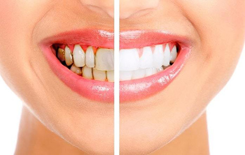 Teeth Whitening in Marmaris