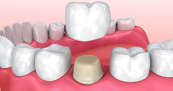 Dental Crown in Marmaris