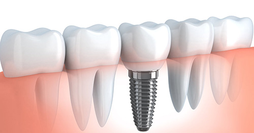 Marmaris Implant