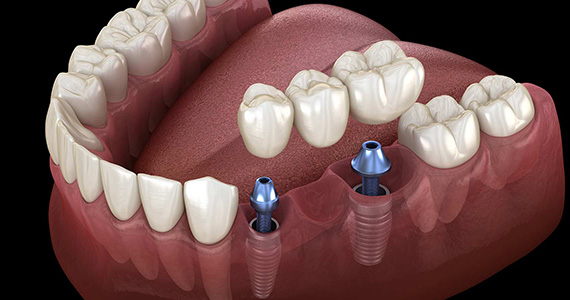 Dental Implant in Marmaris
