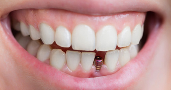Dental Implant in Marmaris