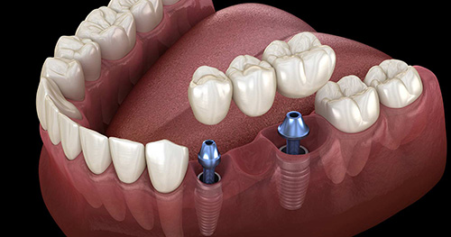 Dental implant turkey