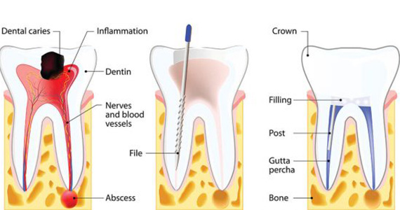 Root Canal Treatment in Marmaris