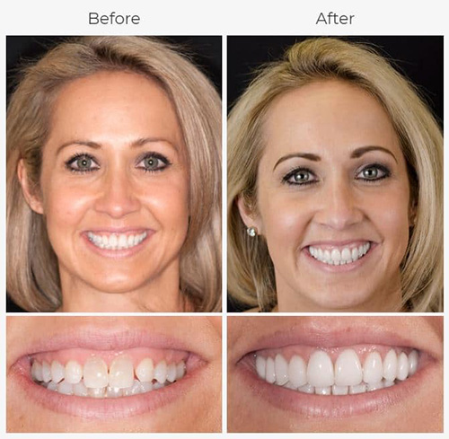 Smile Makeover in Marmaris