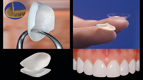 Porcelain Veneers in Marmaris